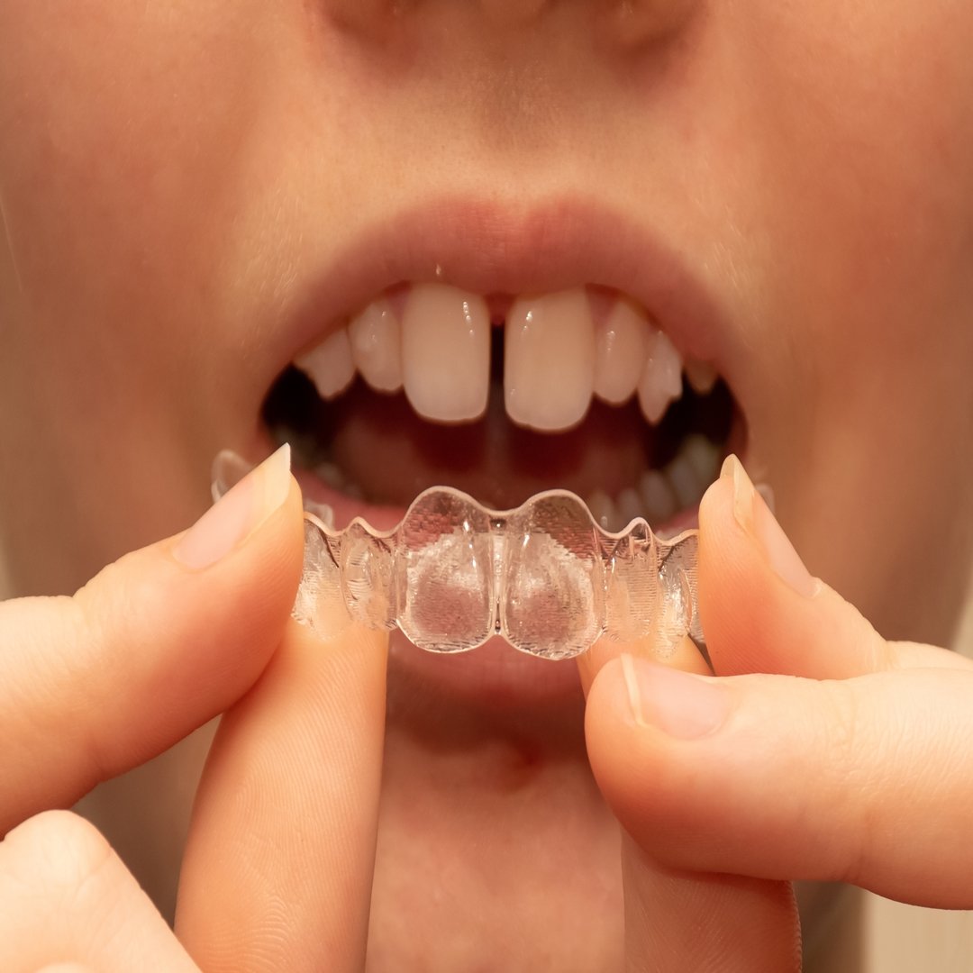 Diastema - O espaço entre os dentes pode se fechar com Invisalign